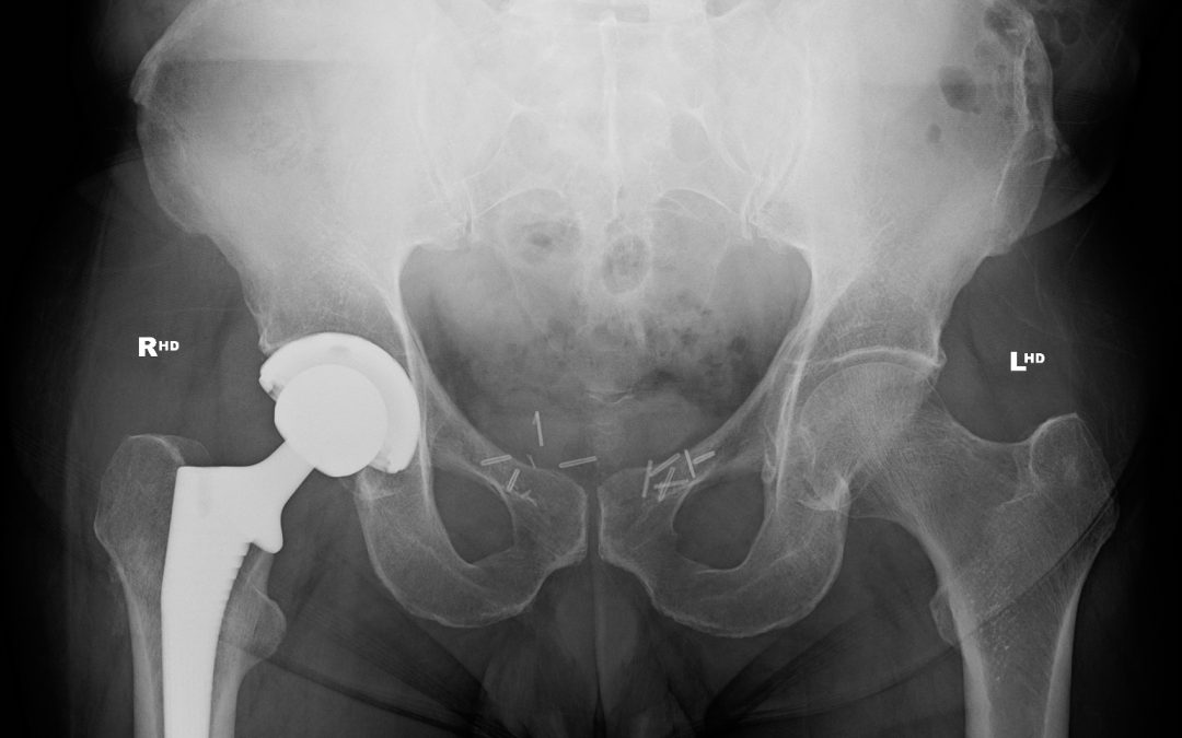 Obesity and hip replacement surgery – Evidence from the Australian National Joint Replacement Registry